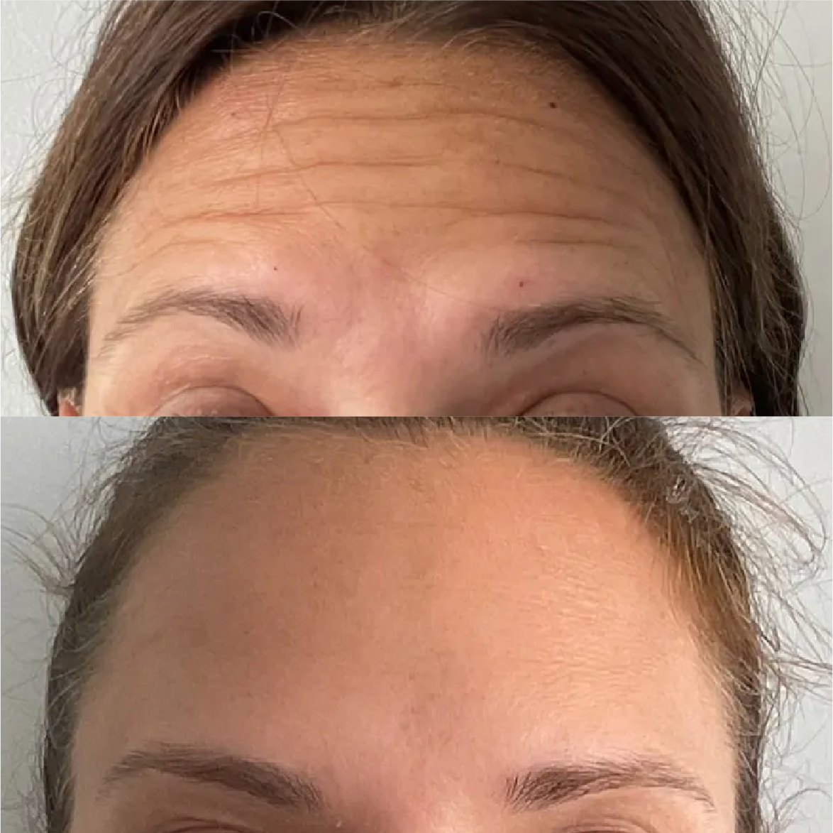 A woman 's forehead before and after botox injections.