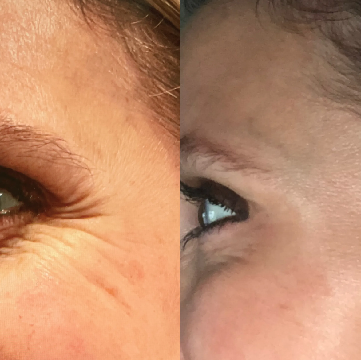 A before and after photo of a woman 's eye and forehead.