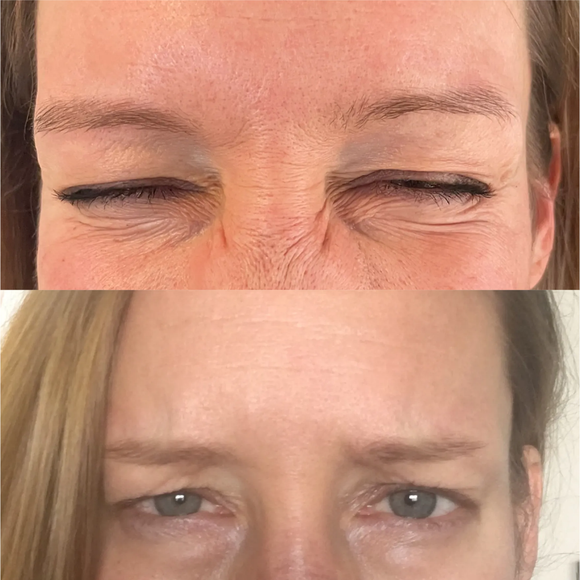 A before and after photo of a woman 's forehead with her eyes closed.