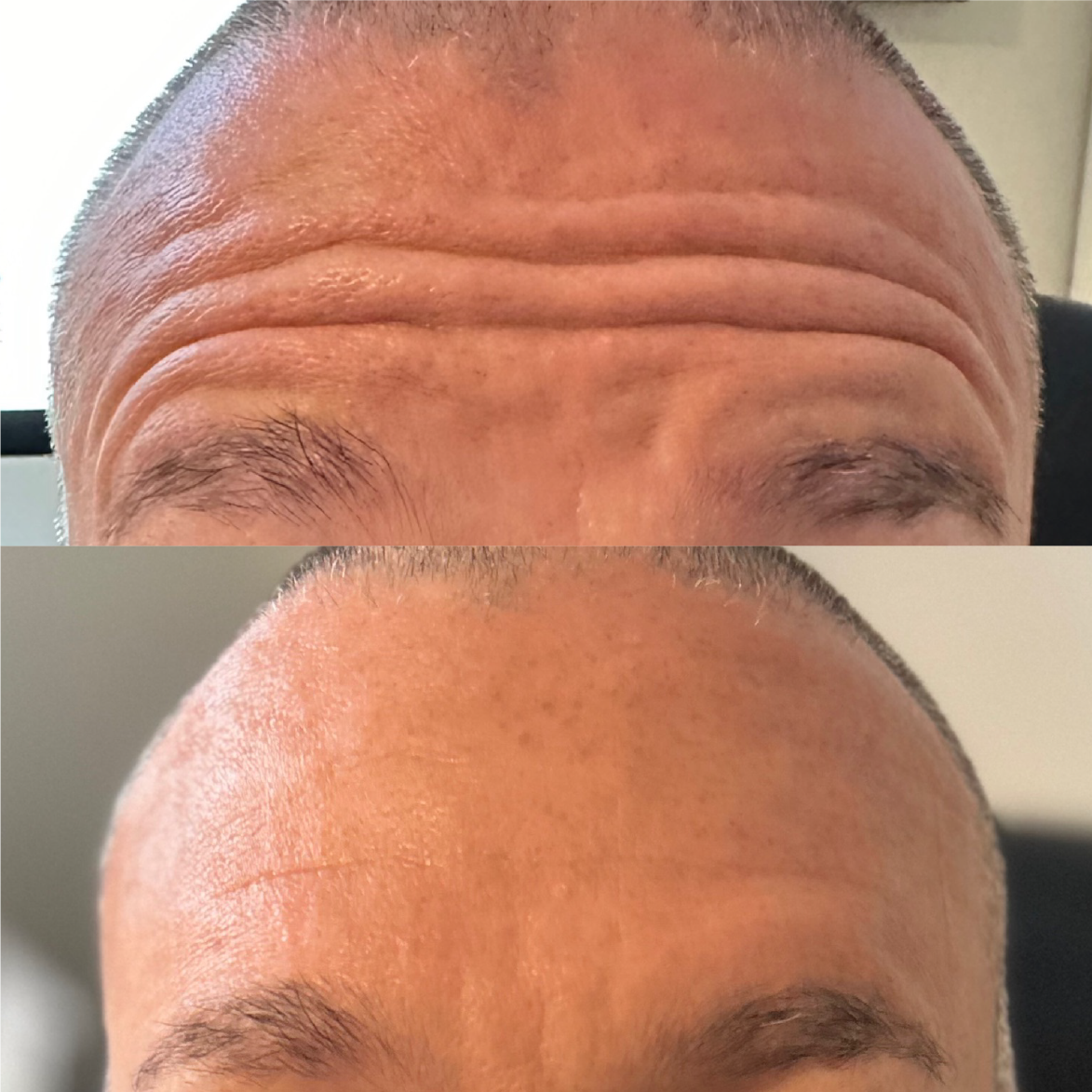 A before and after photo of a man 's forehead with wrinkles.