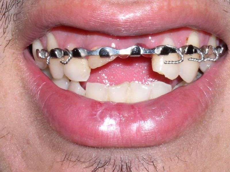 Balboa Dental Clinic - Implantes dentales