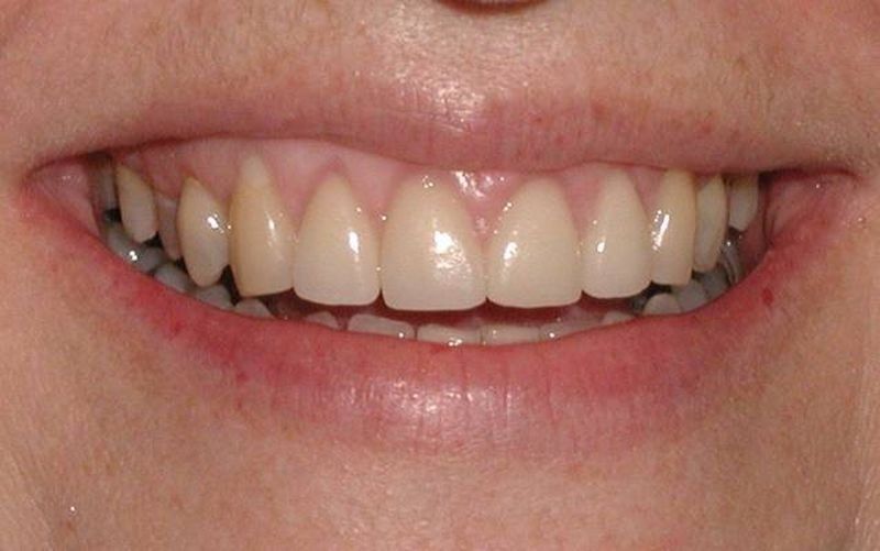 Balboa Dental Clinic - Tratamiento de encías