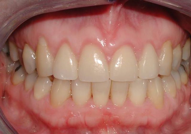 Balboa Dental Clinic - Tratamiento de encías