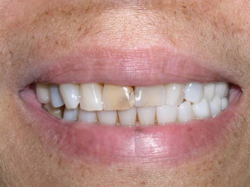 Balboa Dental Clinic - Carilla Porcelana