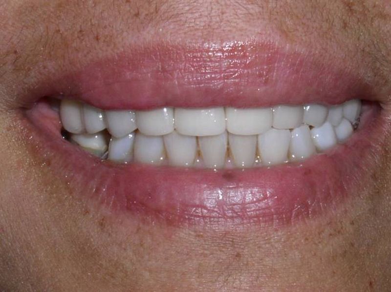 Balboa Dental Clinic - Carilla Porcelana