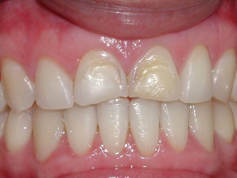 Balboa Dental Clinic - Carilla Porcelana