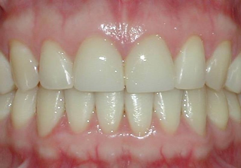 Balboa Dental Clinic - Carilla Porcelana efectiva