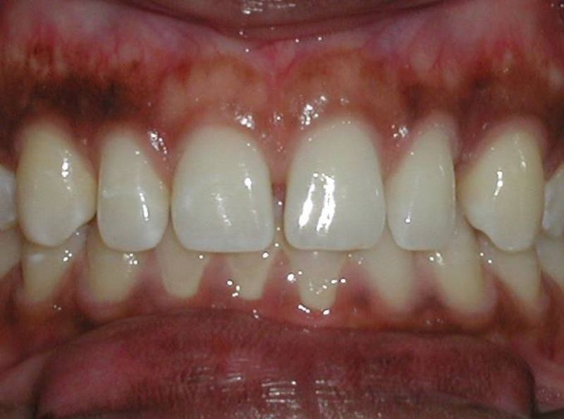 Balboa Dental Clinic - Carilla Porcelana