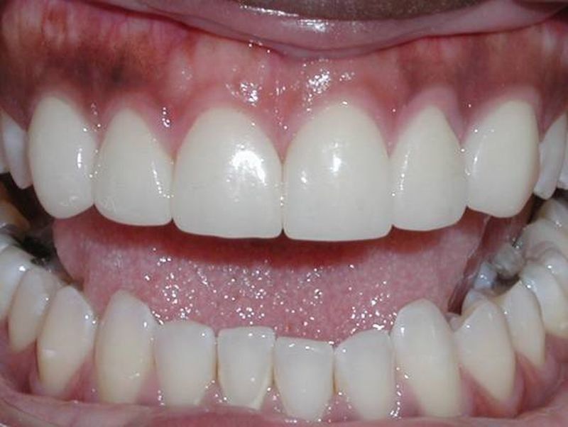 Balboa Dental Clinic - carilla porcelana