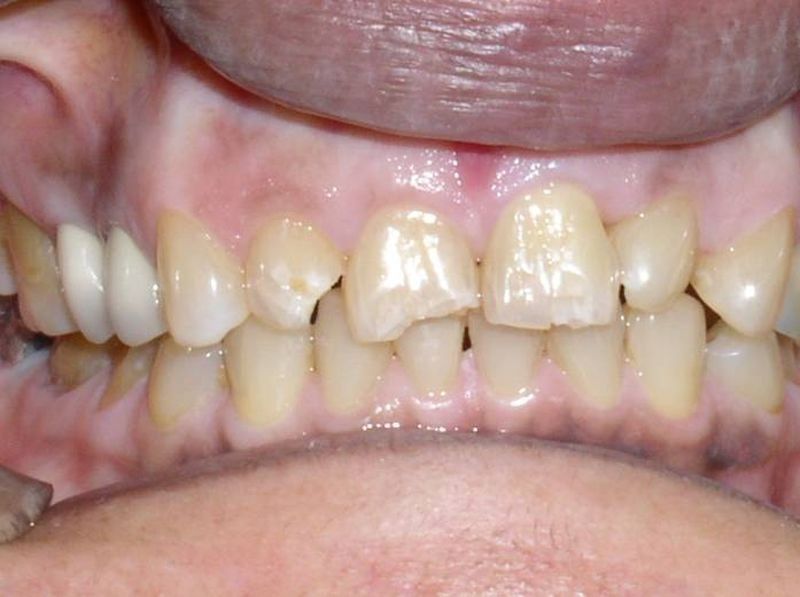 Balboa Dental Clinic - Corona Pocelana