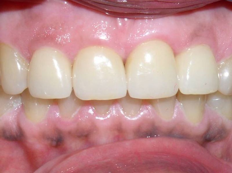 Balboa Dental Clinic - Corona Porcelana