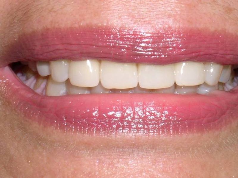 Balboa Dental Clinic - Corona Porcelana