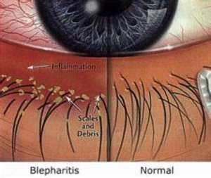 Blepharitis Treatment