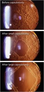 YAG laser posterior capsulotomy