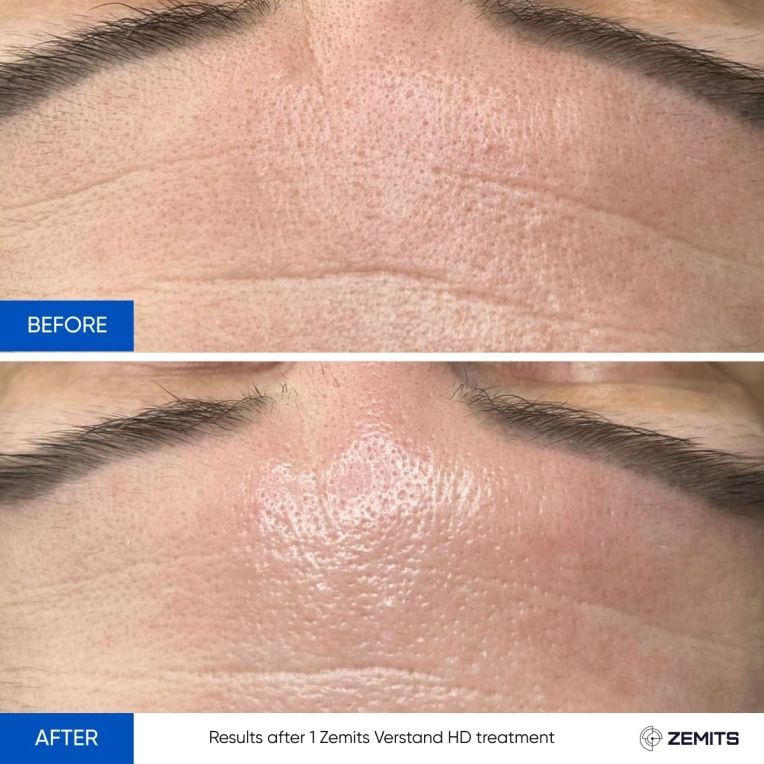 A before and after photo of a woman 's face