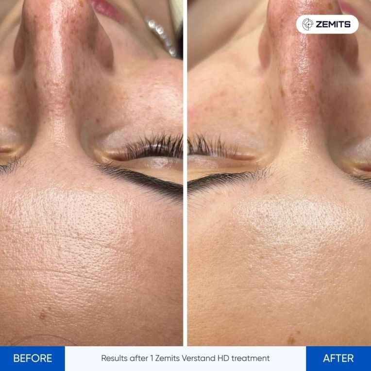 A before and after photo of a woman 's face