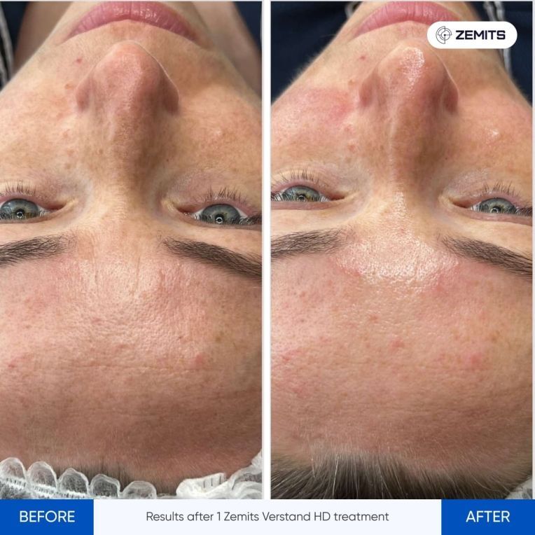 A before and after photo of a woman 's face
