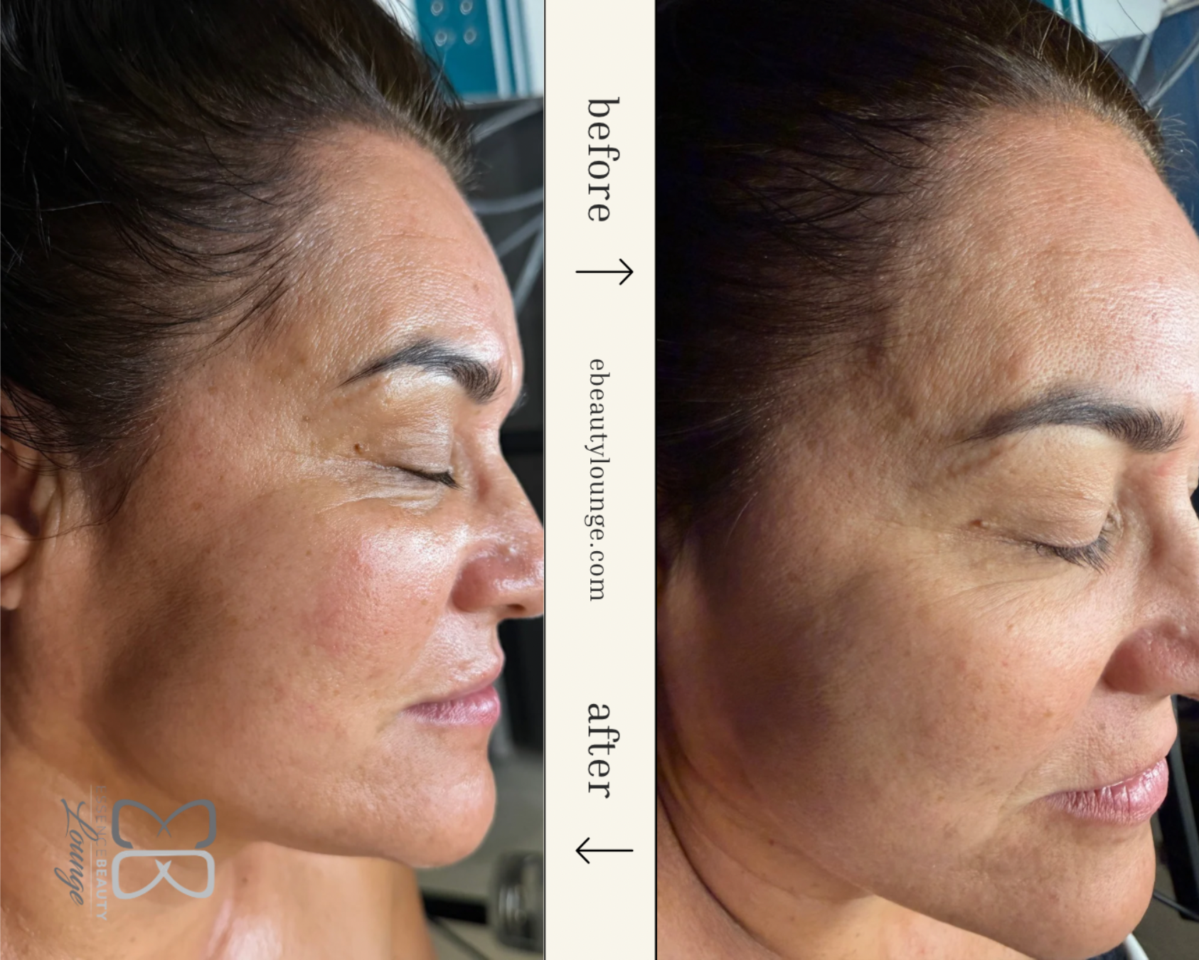 Side-by-side comparison of a person's face. Left side: before, showing wrinkles. Right side: after, smoother skin.