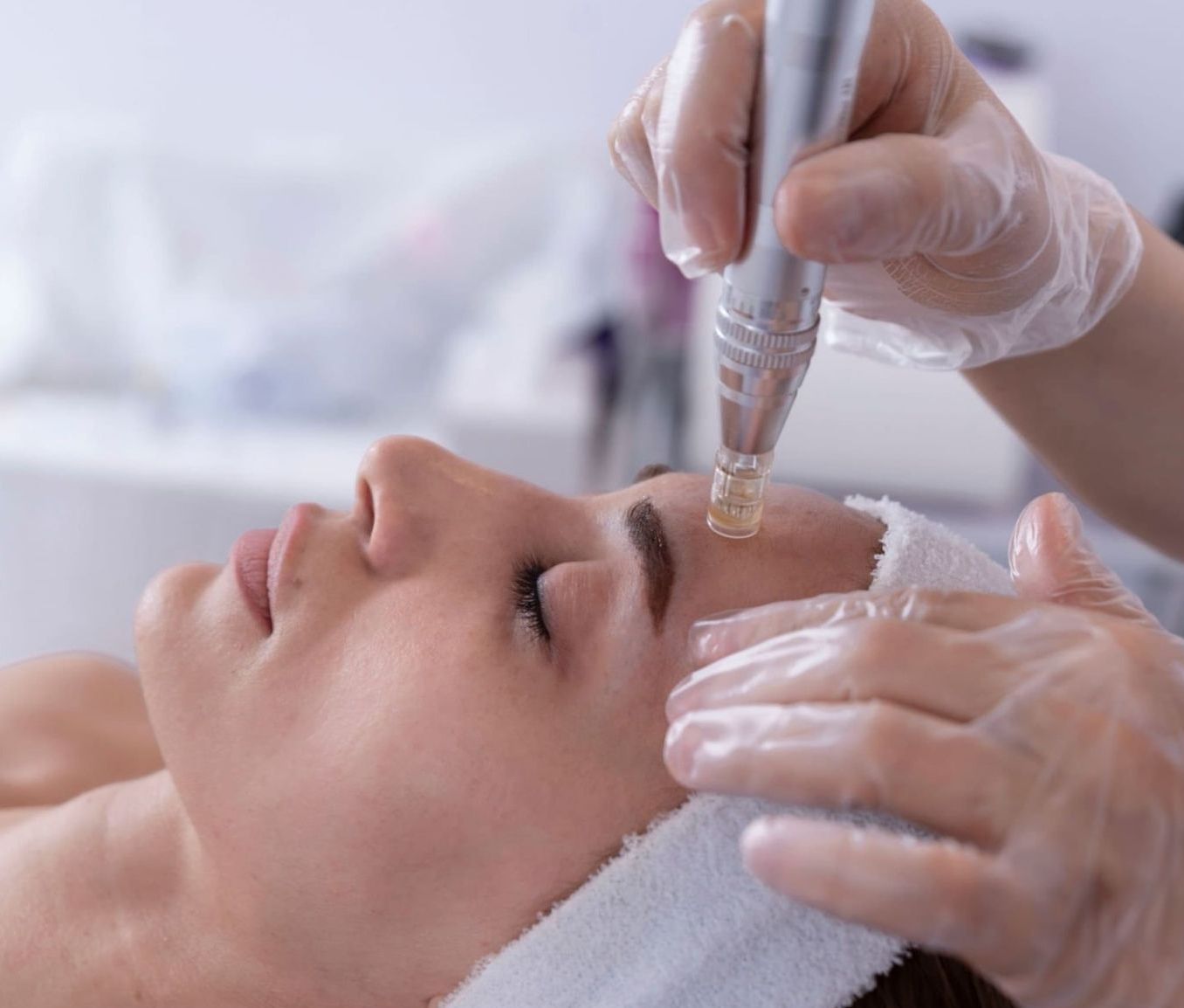 Microneedling Dr Ghizlaine HAYOU: Médecin Esthétique