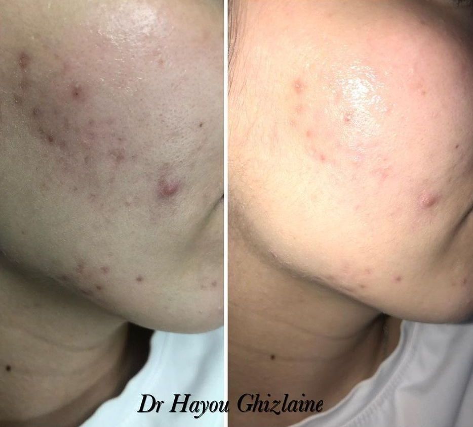 microneedling à agadir dr ghizlaine hayou