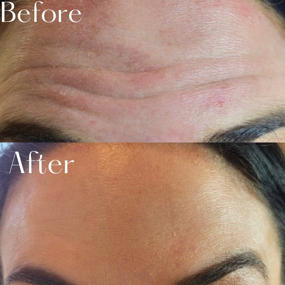Before and after comparison of forehead wrinkles, smoothed after treatment.