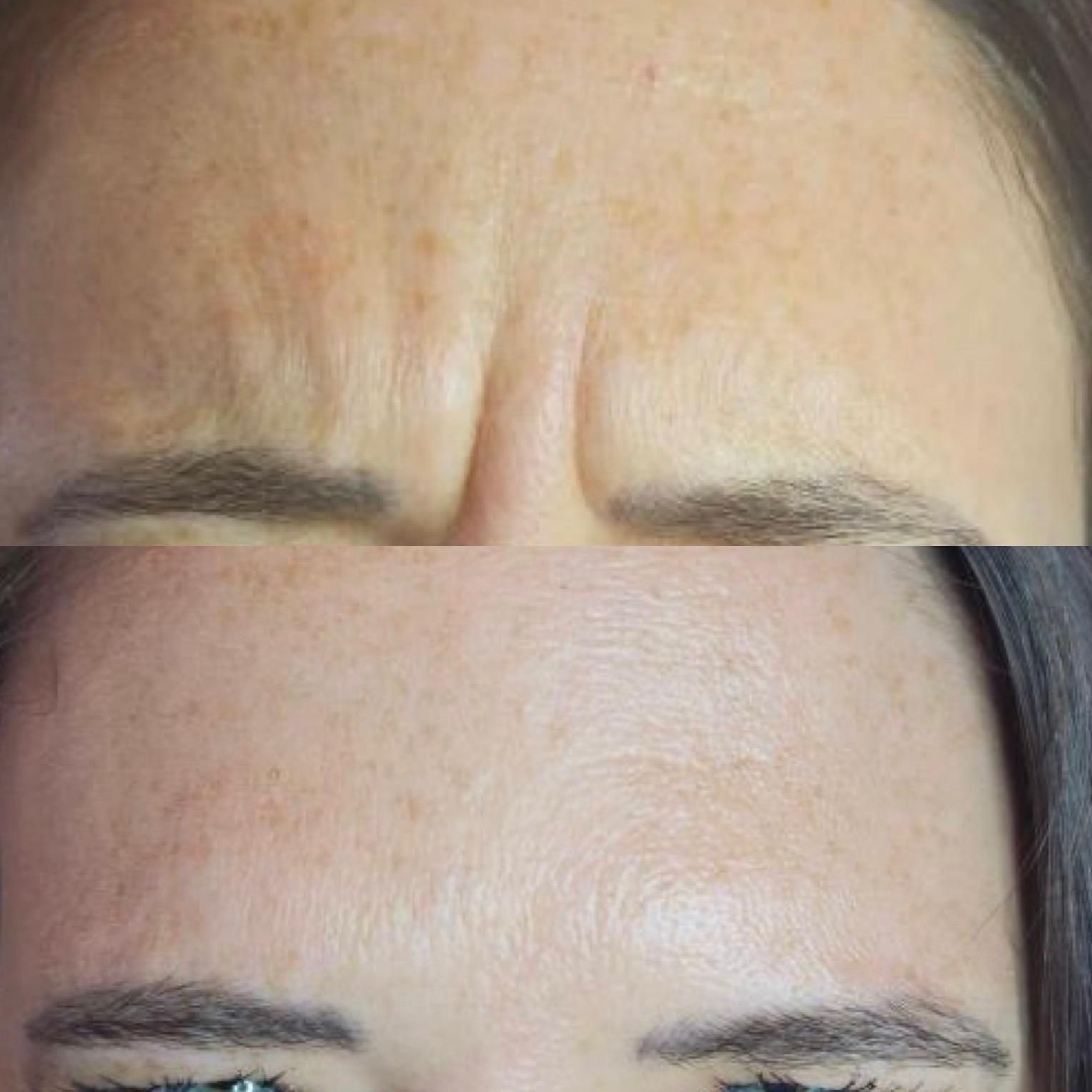 Before and after comparison of forehead wrinkles, smoothed after treatment.