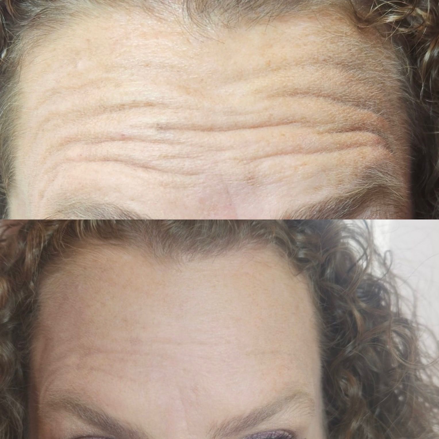 Forehead with wrinkles (top), smooth forehead (bottom) after treatment.