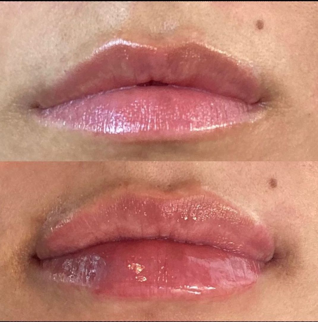 Two photos of lips, before and after a procedure. The lower lip appears swollen and discolored in the second photo.