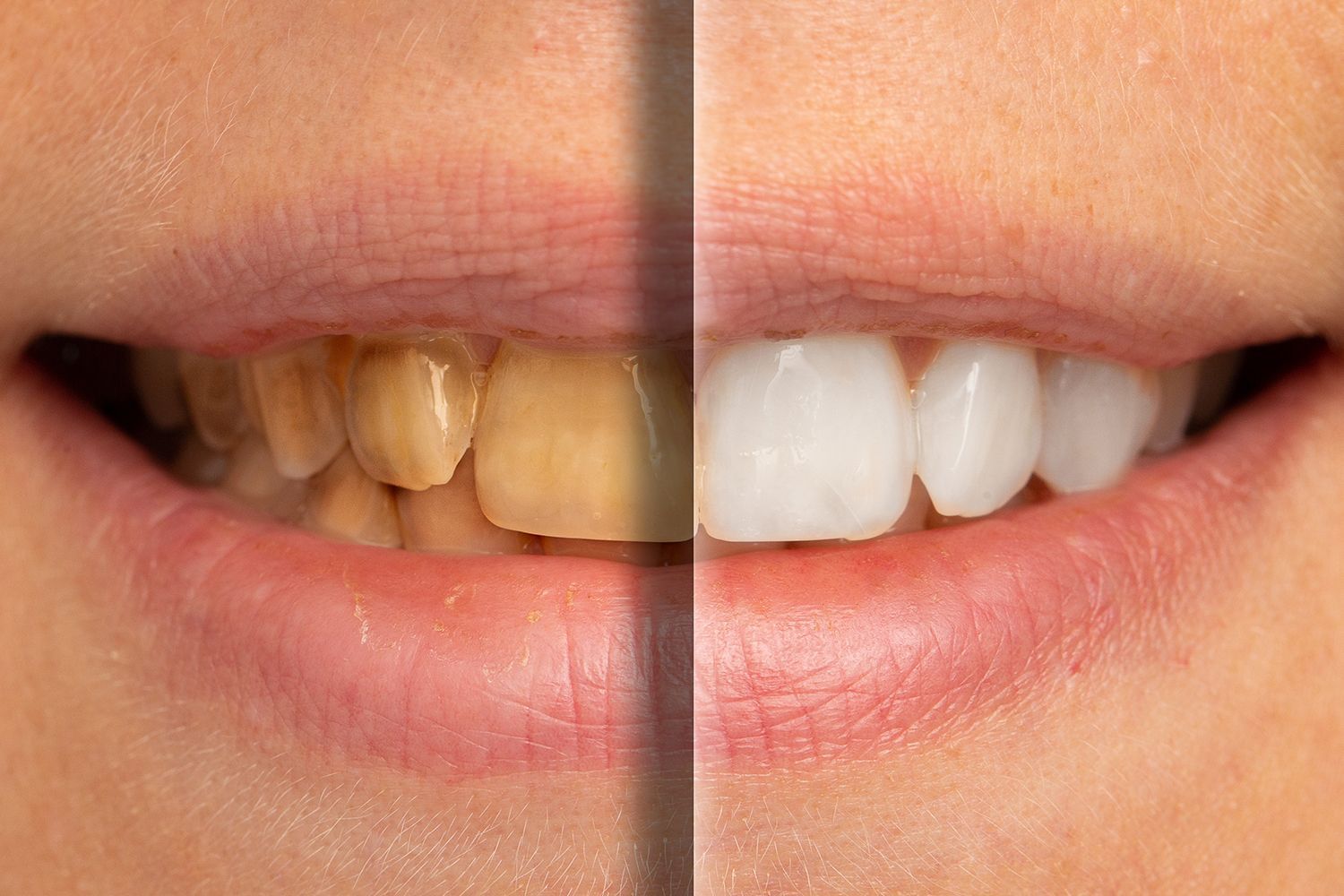 Smile of a patient showcasing a before and after of a cosmetic dentistry whitening procedure.