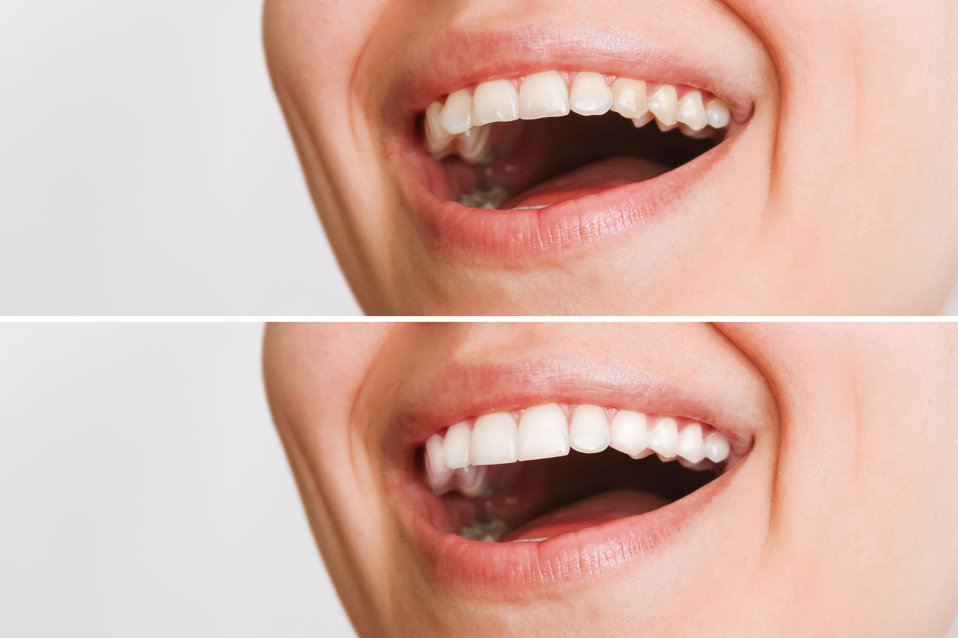 Cropped shot of a smiling woman showcasing the before and after a veneers procedure.