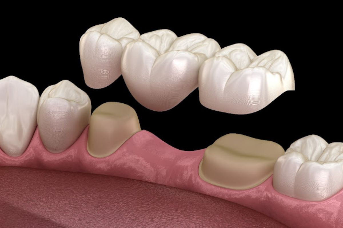 Dental bridge model shows bridge with attached crowns, anchored by two crowned teeth.