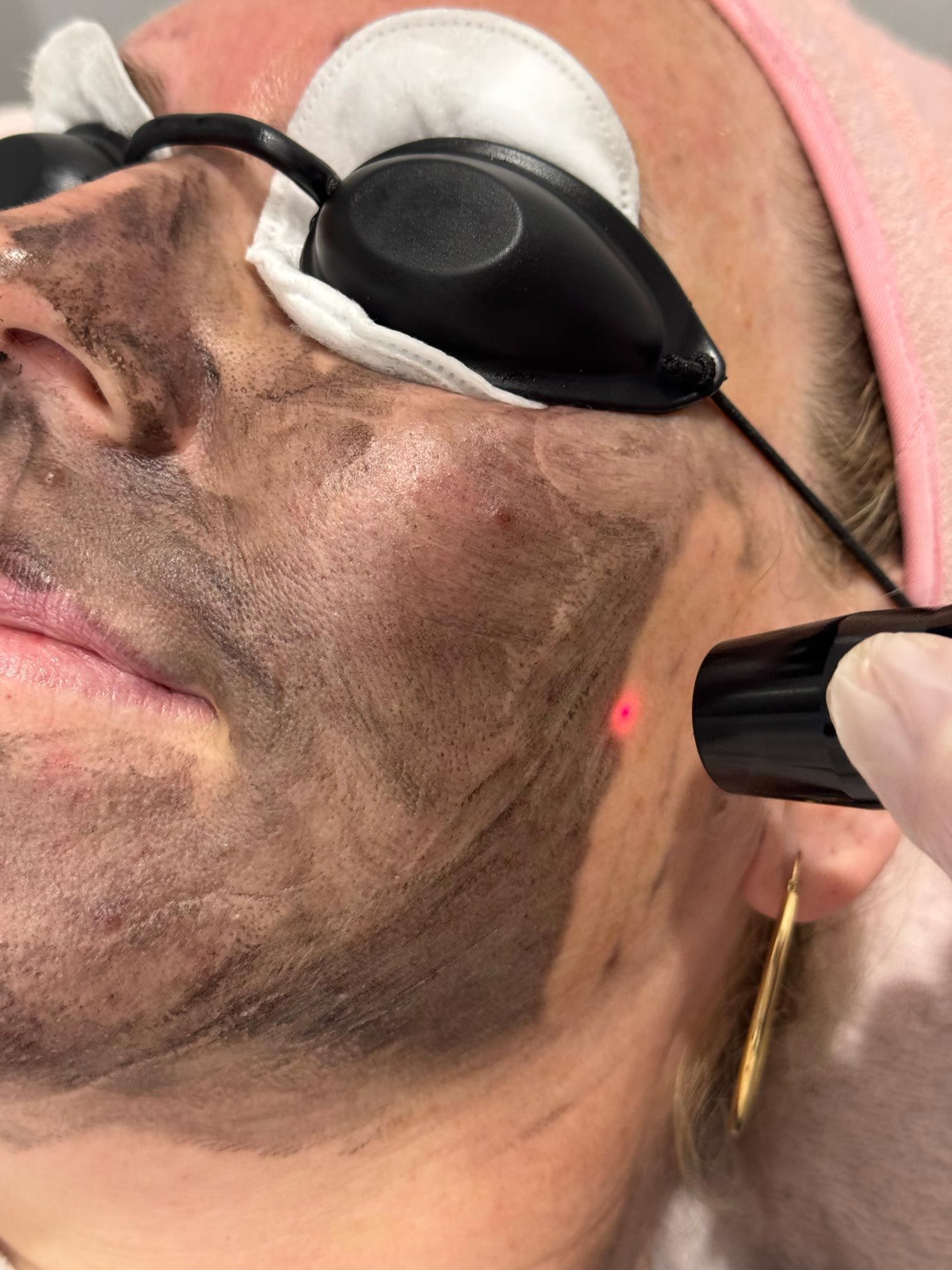 A woman is getting a laser treatment on her face.