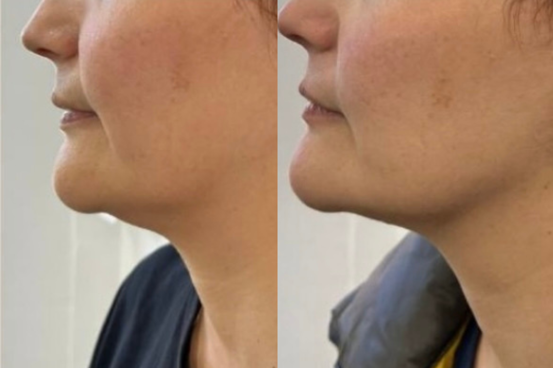 A close up of a woman 's face with blue circles on it