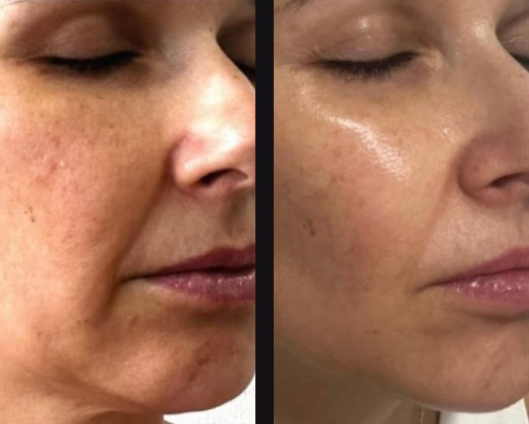 A woman is getting a laser treatment on her face.