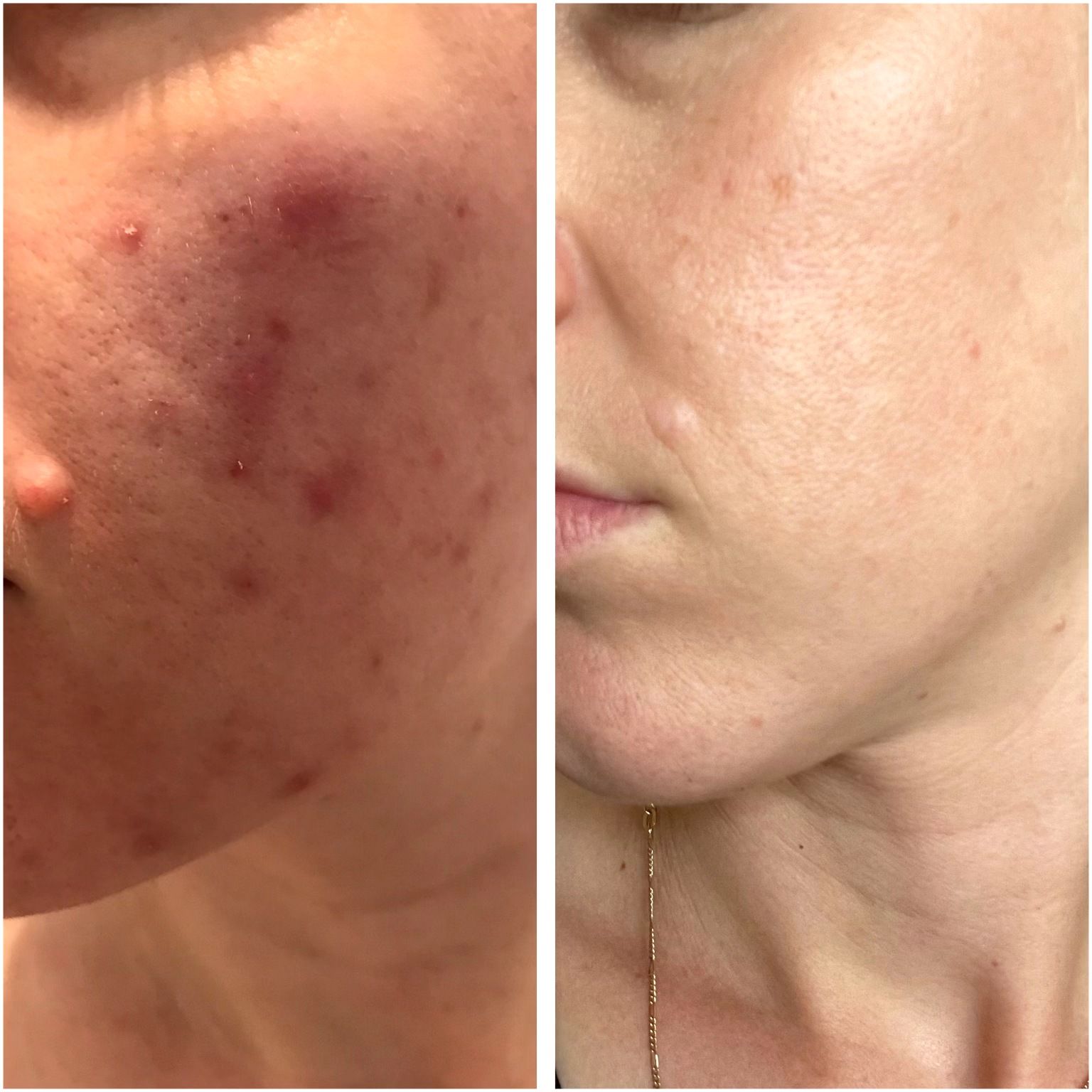 A woman is giving a woman a facial treatment.