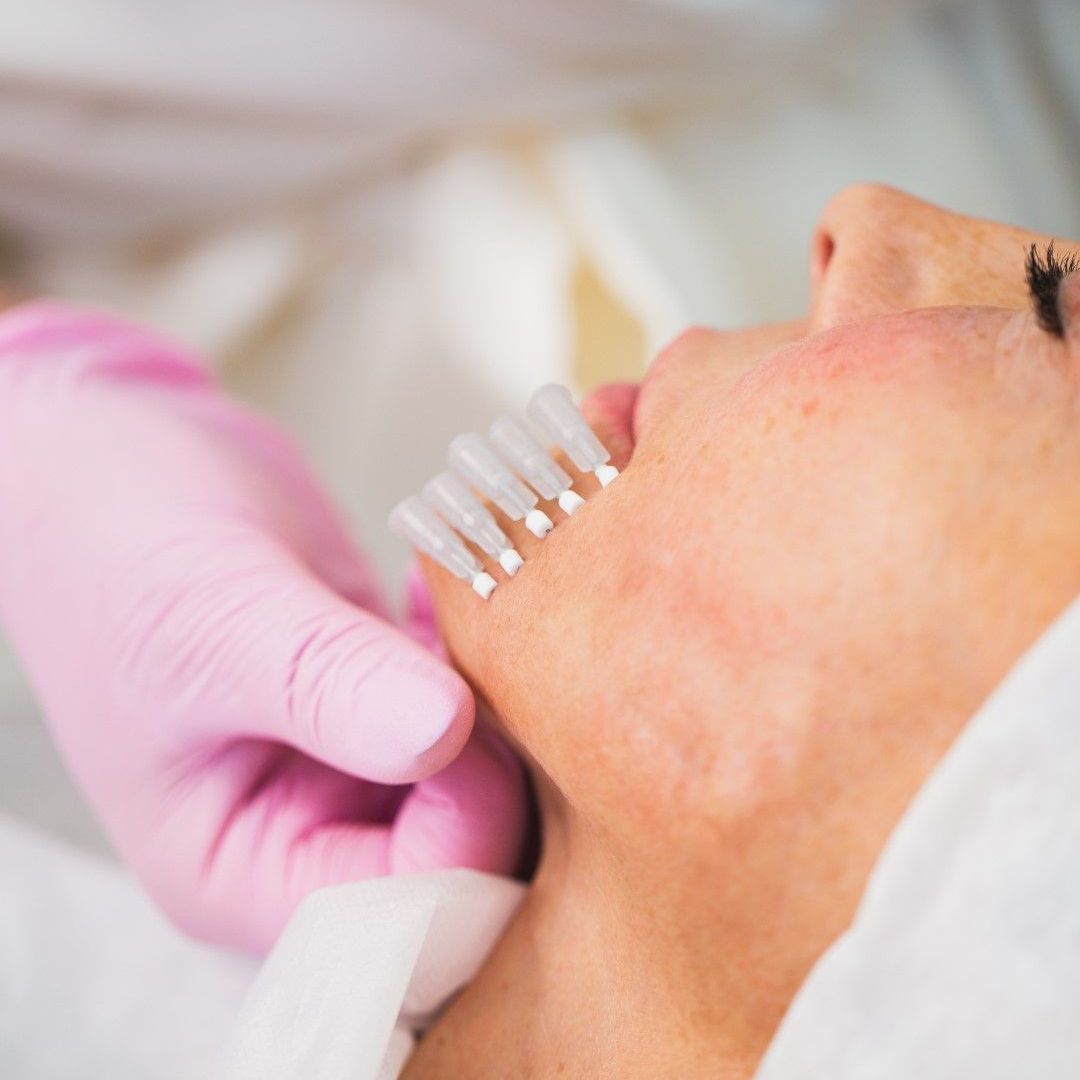 A woman is getting a laser treatment on her face.