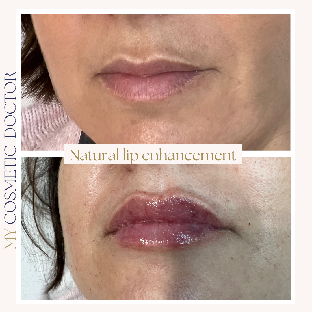 A before and after photo of a woman 's natural lip enhancement