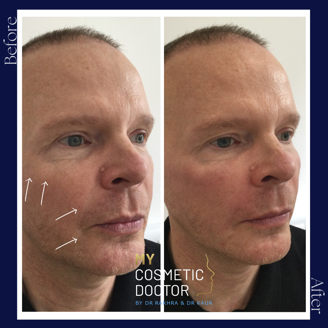 A before and after photo of a man 's face by my cosmetic doctor