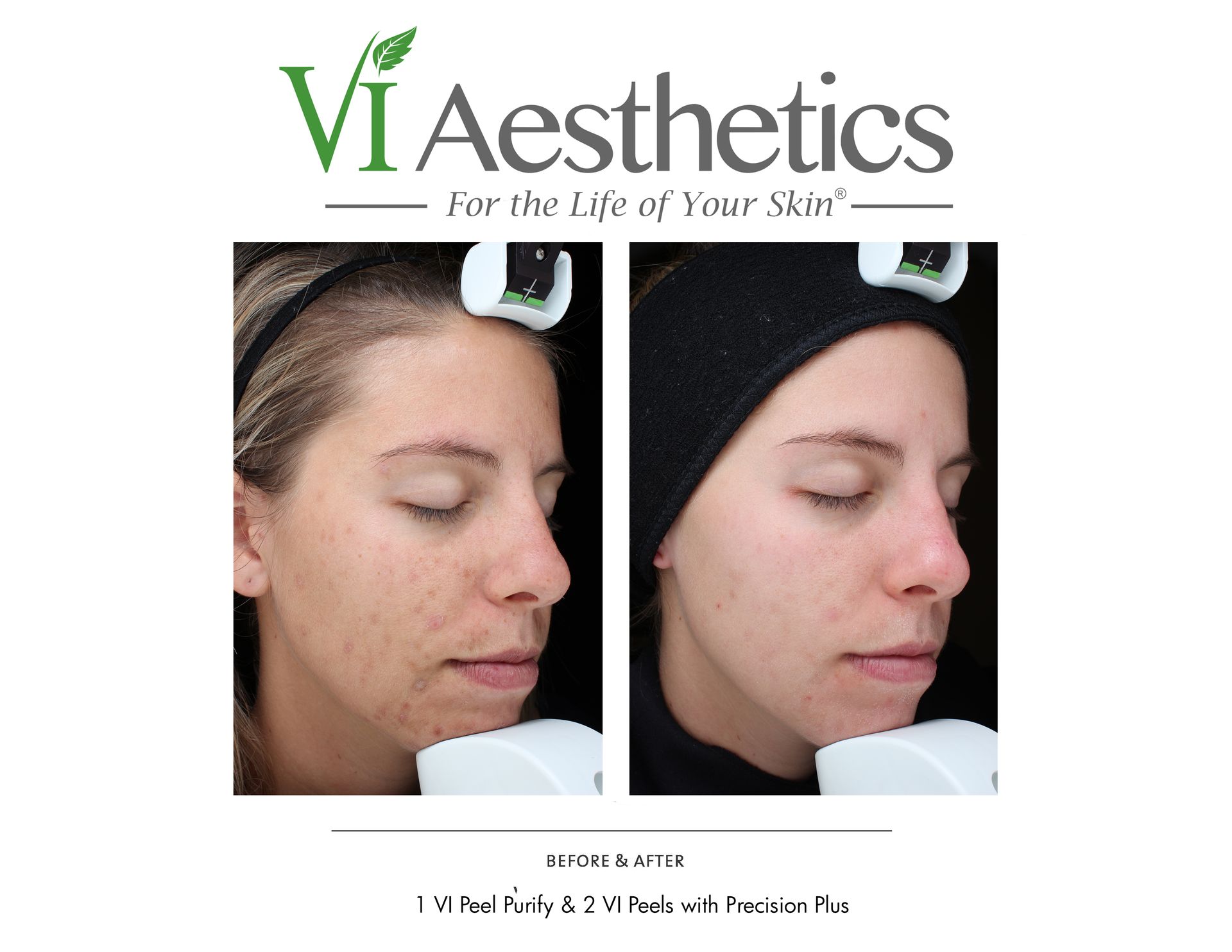 A before and after photo of a woman 's face for vi aesthetics