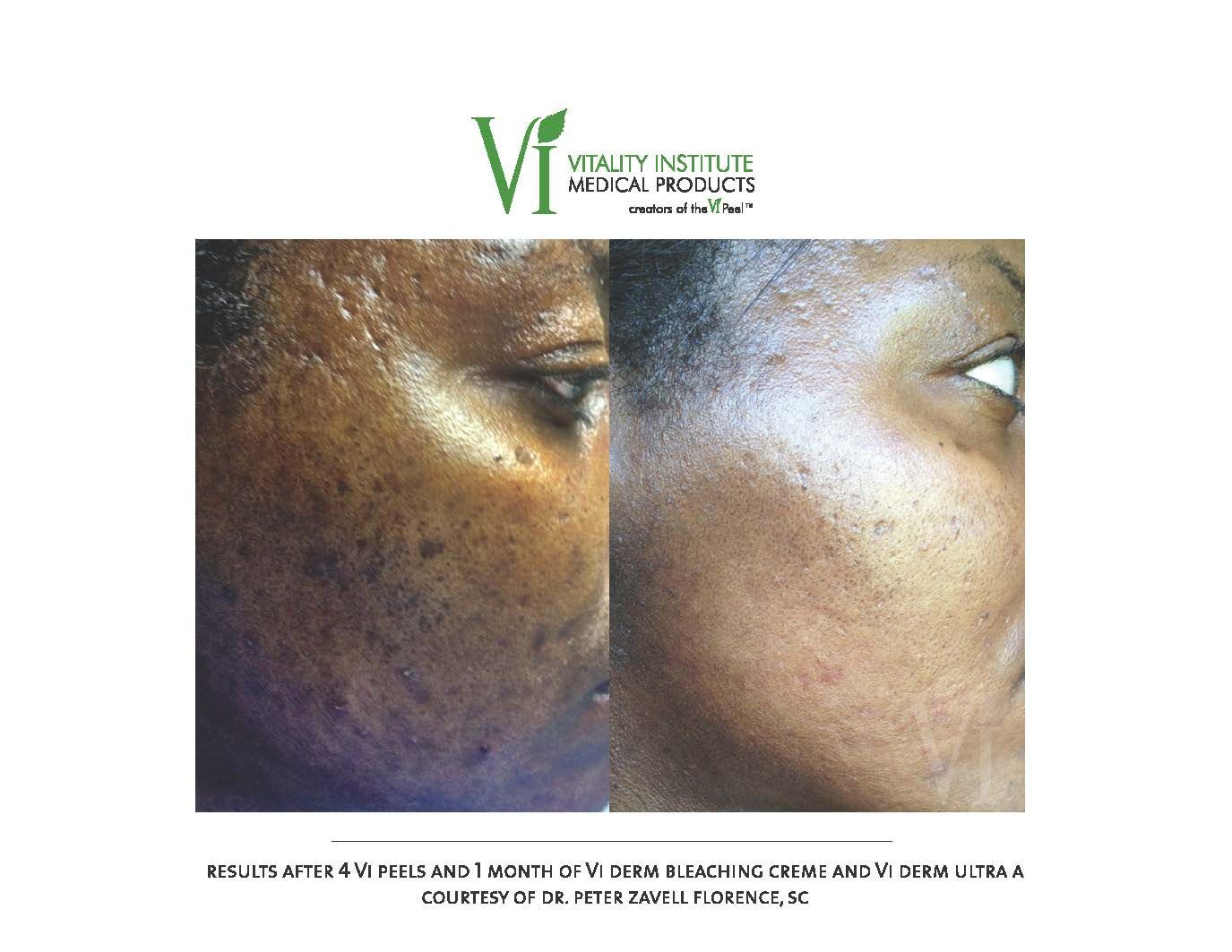 A before and after photo of a woman 's face