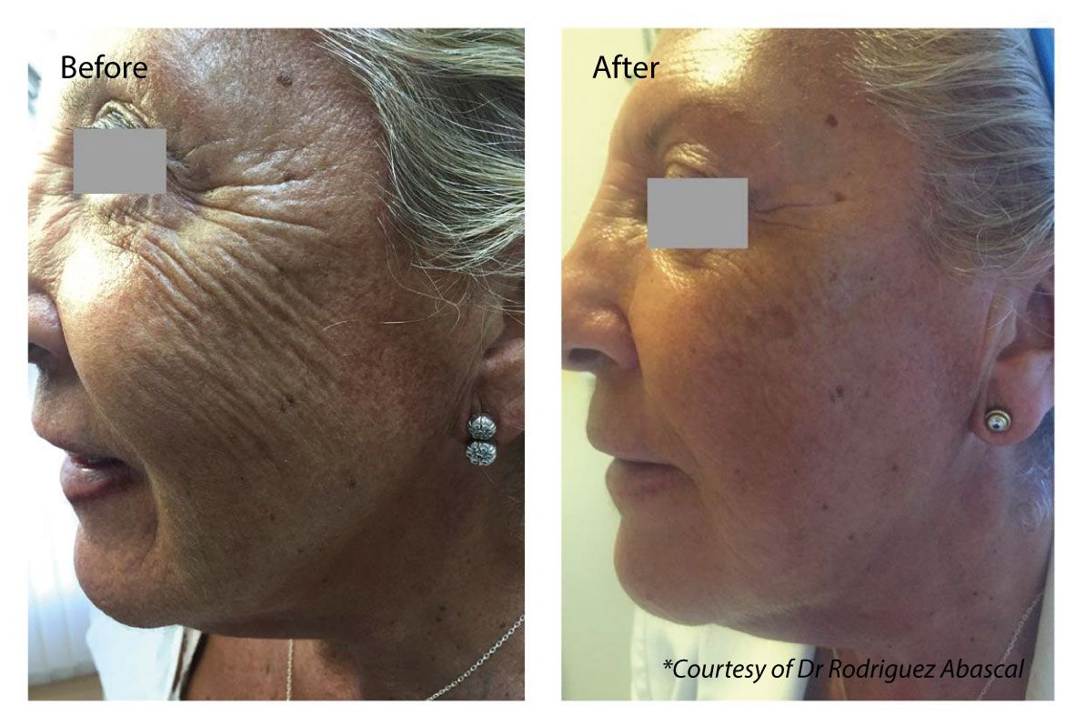 A before and after photo of an older woman 's face