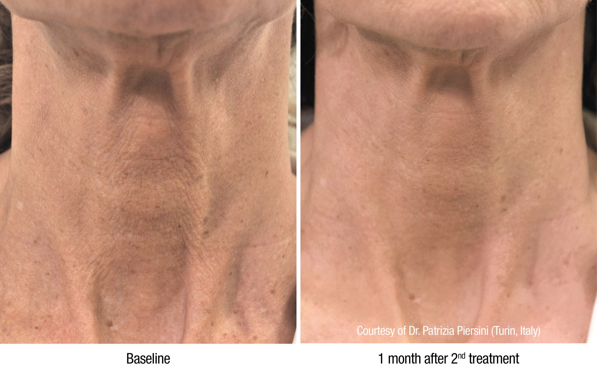 A before and after photo of a woman 's neck and chest