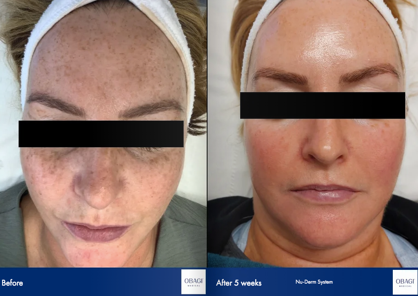 A before and after photo of a woman 's face