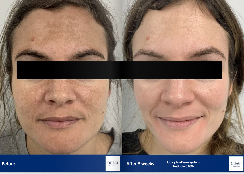 A before and after photo of a woman 's face.