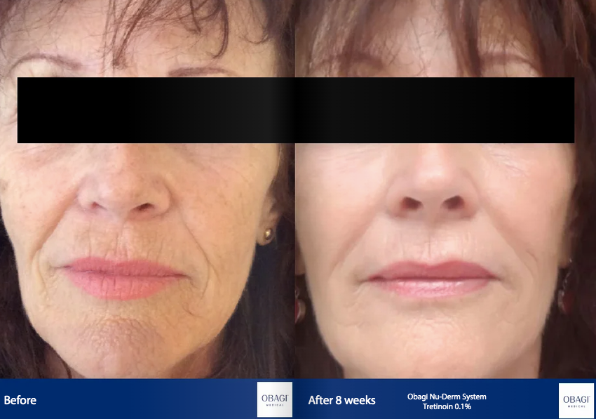 A before and after photo of a woman 's face.