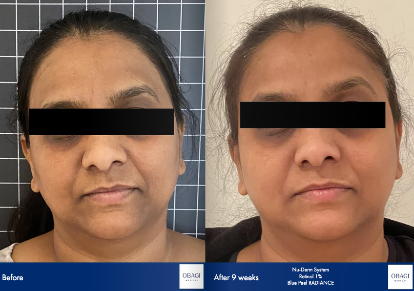 A before and after photo of a woman 's face.