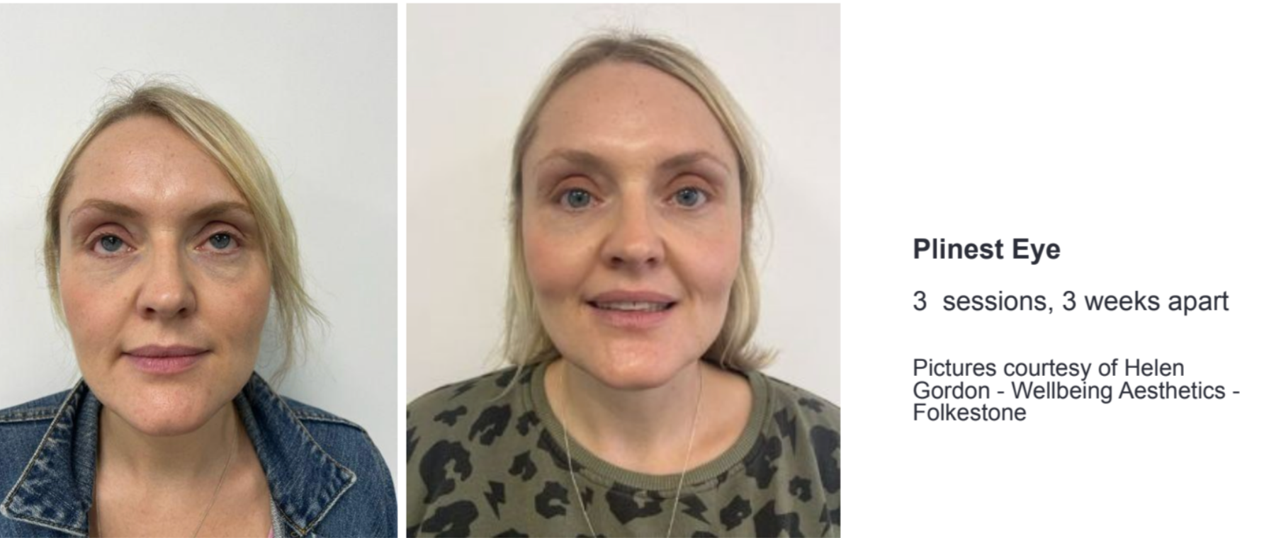 Three pictures of a woman 's face before and after a treatment.