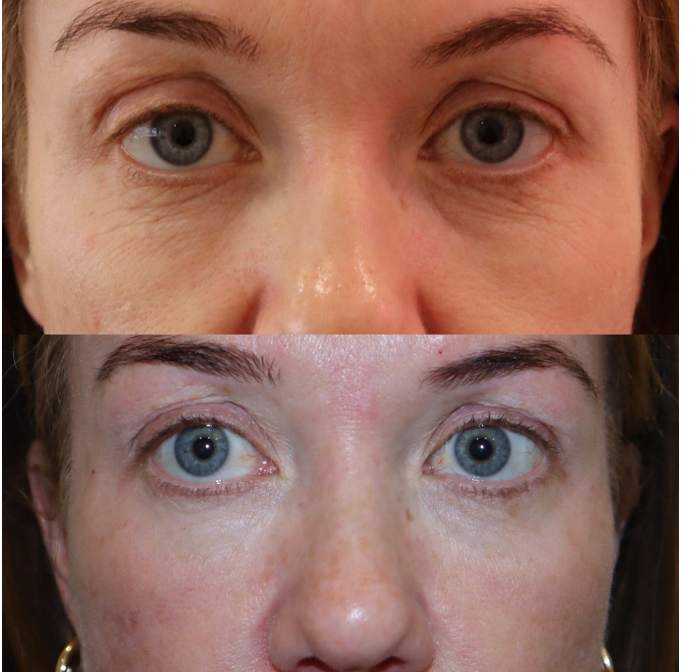 amazing under eye transformation
