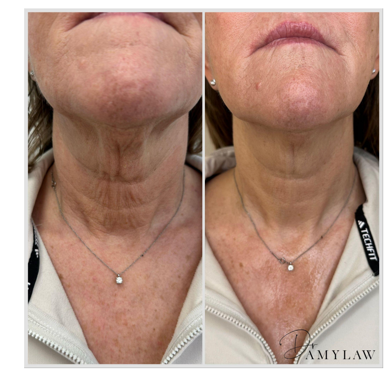 A before and after photo of a woman 's neck and neckline