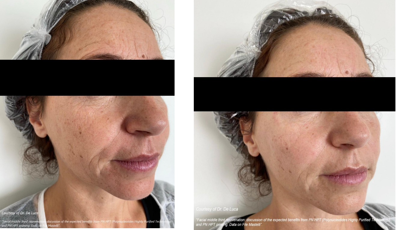 A before and after photo of an older woman 's face